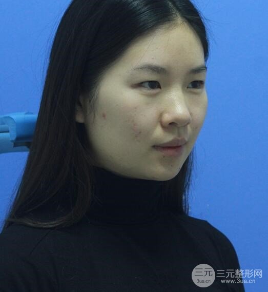 重慶park雙眼皮手術(shù)反饋