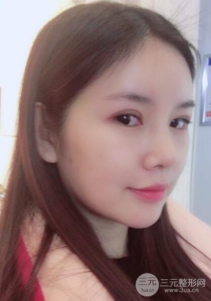 重慶park雙眼皮手術(shù)反饋