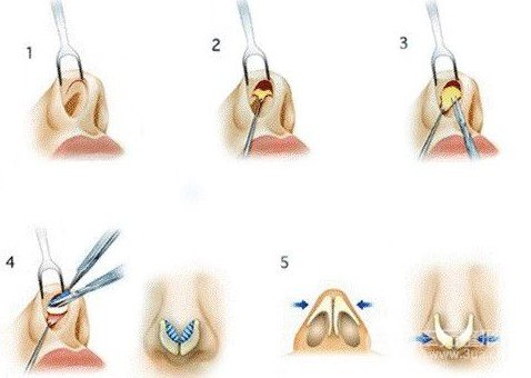 隆鼻手術(shù)方法