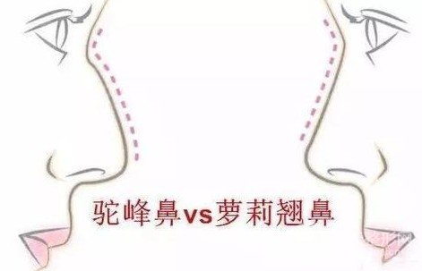 駝峰鼻子是怎么來的