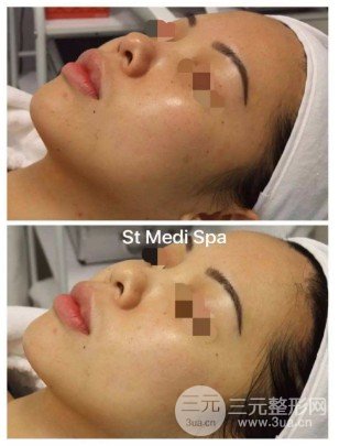 光子嫩膚后怎么護(hù)理