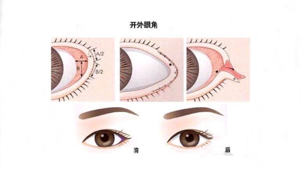 開眼角需要多少錢