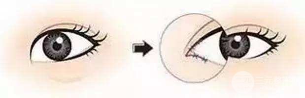 開眼角手術多久能恢復