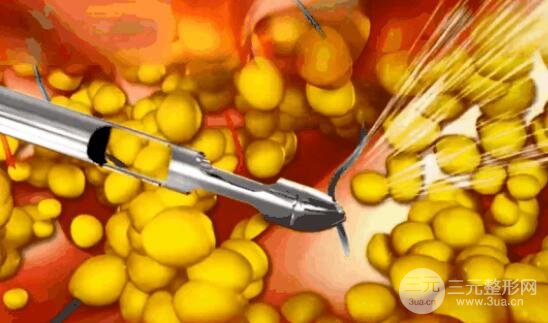 外科吸脂術(shù)的原理