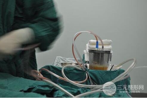 吸脂方式總結(jié)