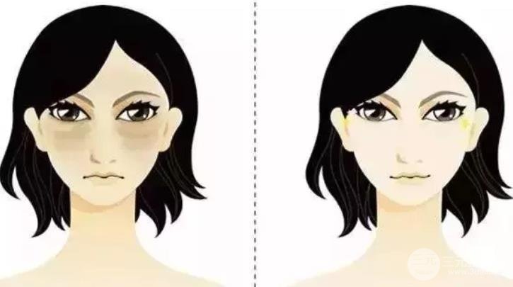 祛眼袋手術(shù)會(huì)反彈嗎