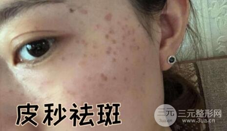 蜂巢激光祛斑案例術(shù)前