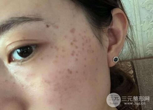 蜂巢激光祛斑案例術(shù)后一個(gè)月