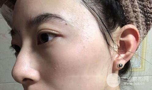 蜂巢激光祛斑案例術(shù)后2個(gè)月