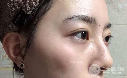 蜂巢激光祛斑案例術(shù)后4個(gè)月