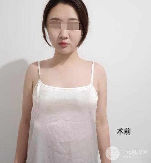 上海九院隆胸案例術(shù)前