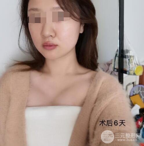 上海九院隆胸案例術(shù)后6天