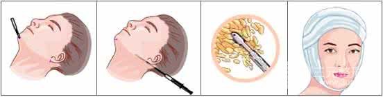 雙下巴吸脂需要注意什么?