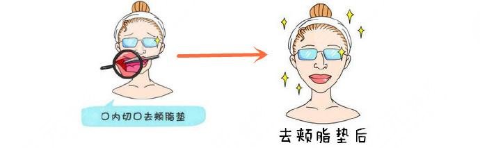 去頰脂墊后的注意事項(xiàng)