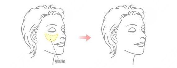 去頰脂墊有什么危害