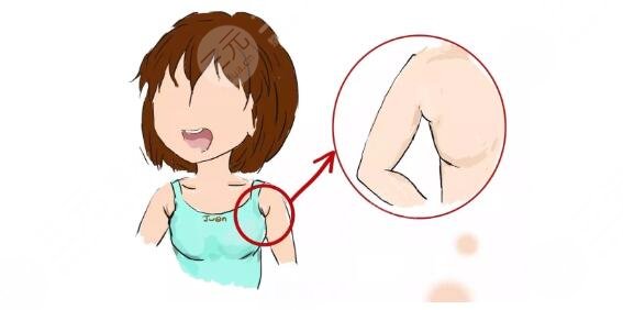 副乳吸脂的優(yōu)缺點(diǎn)如下