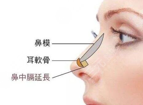 進口膨體隆鼻一般要多少錢?