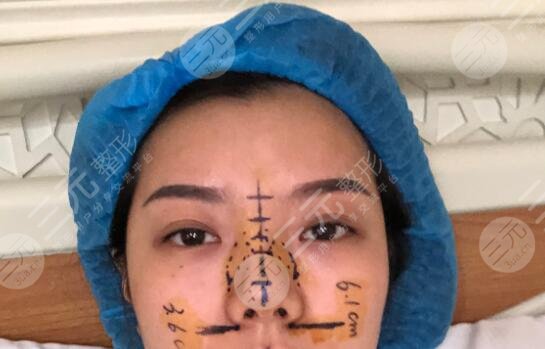 進(jìn)口膨體隆鼻案例前