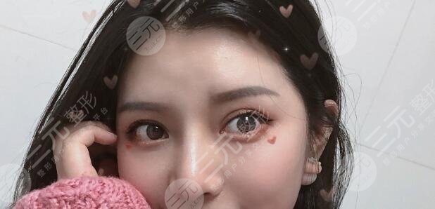 進(jìn)口膨體隆鼻案例后