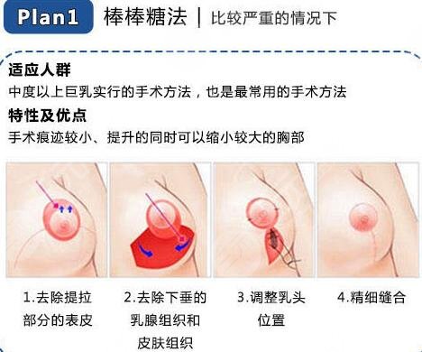 巨乳縮小手術(shù)過程
