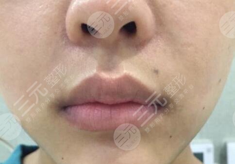 厚唇改薄整形手術(shù)圖片