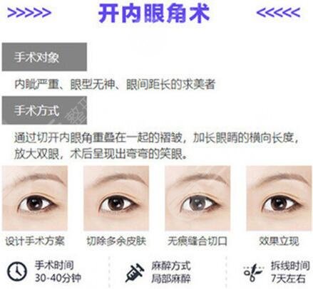 什么人適合開眼角