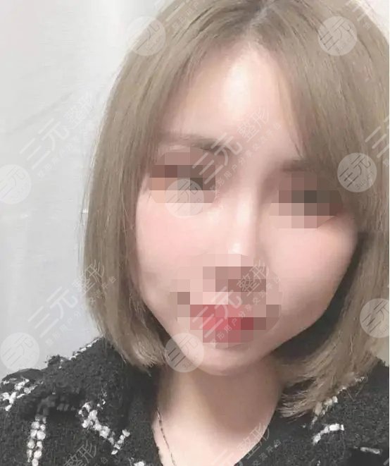 五v明星是埋線除皺?知識(shí)科普來嘍！附真人案例！