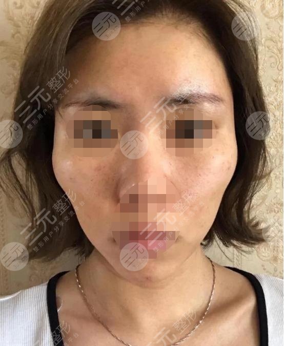 五v明星是埋線除皺?知識(shí)科普來嘍！附真人案例！