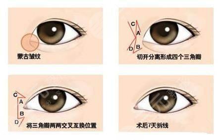 開眼角手術(shù)大約費(fèi)用