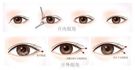 開眼角手術(shù)大約費(fèi)用