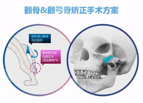 什么樣的人不適合做磨骨瘦臉手術(shù)?