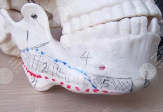 磨骨瘦臉手術(shù)