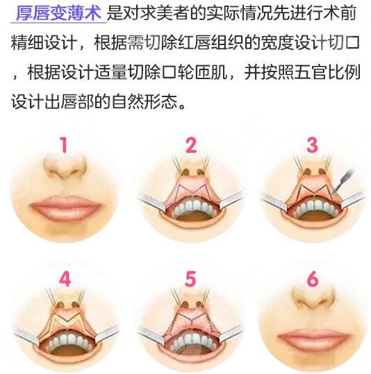 厚唇改薄手術(shù)降低風(fēng)險(xiǎn)嗎