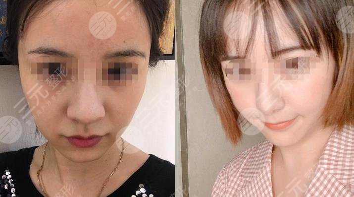 上海九院做光子嫩膚過程圖片