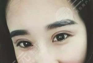 雙眼皮