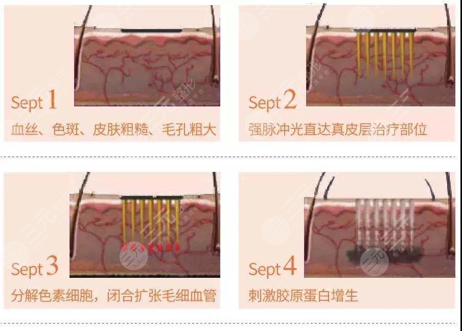 復(fù)合彩光緩解