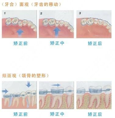 佩戴牙套需要注意的事項(xiàng)