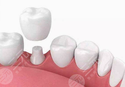 美容冠多少錢一顆