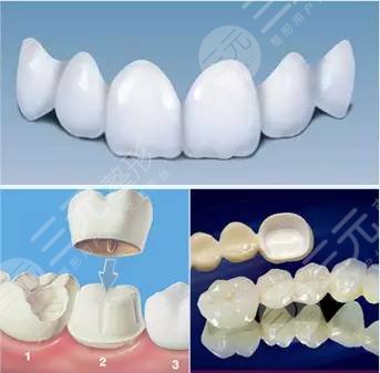 美容冠多少錢一顆?美容冠真人案例，附注意事項！