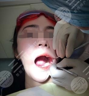 美容冠真實圖片