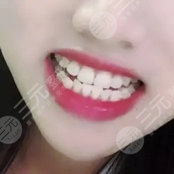 美容冠真實圖片