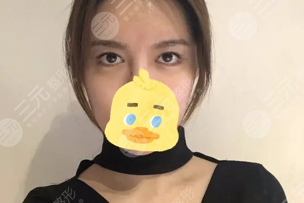 8mm雙眼皮手術案例