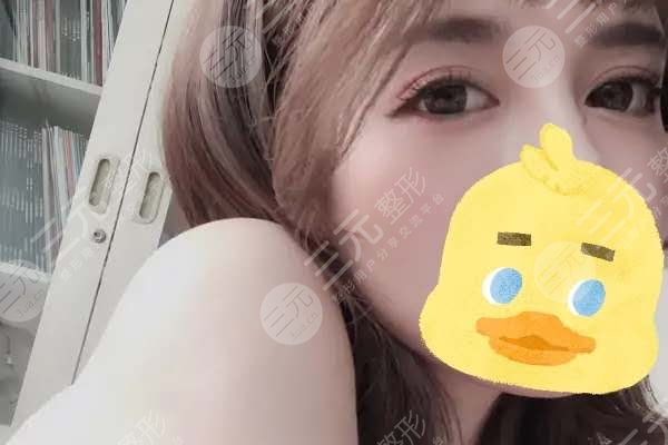 8mm雙眼皮手術案例