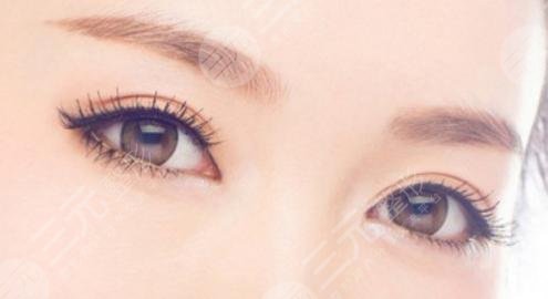 8mm雙眼皮恢復后是多寬