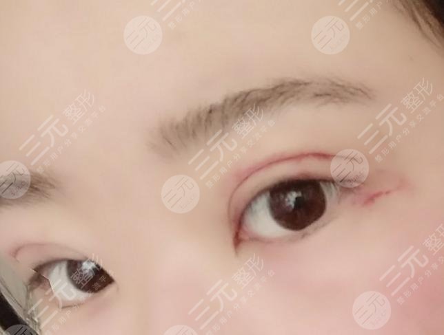 蘭大二院整形科專家雙眼皮案例