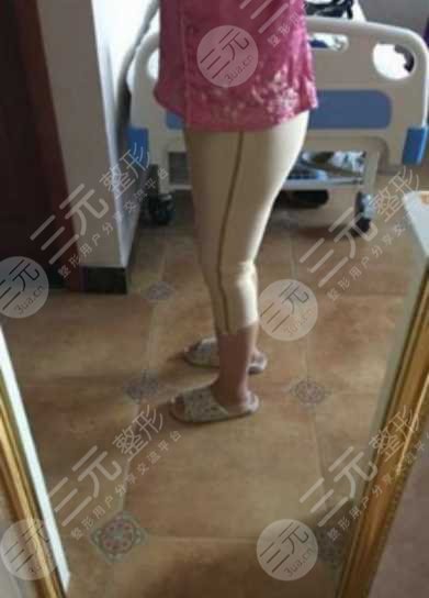 煙臺(tái)山醫(yī)院張文安吸脂后一個(gè)月