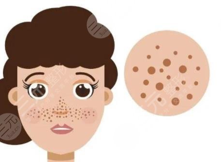 激光去黃褐斑前注意事項