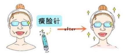 注射瘦臉作用