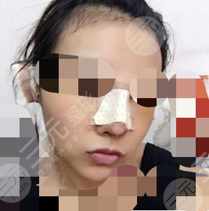 隆鼻前后對(duì)比果圖片