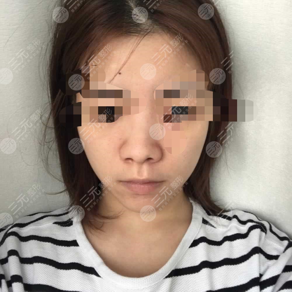 隆鼻前后對(duì)比果圖片